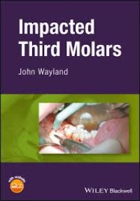 Image of Impacted Third Molars