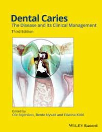 Image of Dental Caries : The Disease And Its Clinical Management