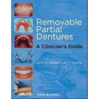 Removable Partial Dentures : A Clinician's Guide