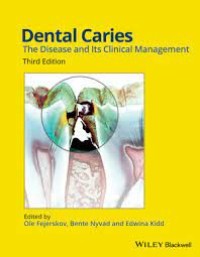 Dental Caries : The Disease And Its Clinical Management